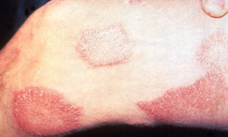 Sintomas da lepra na pele