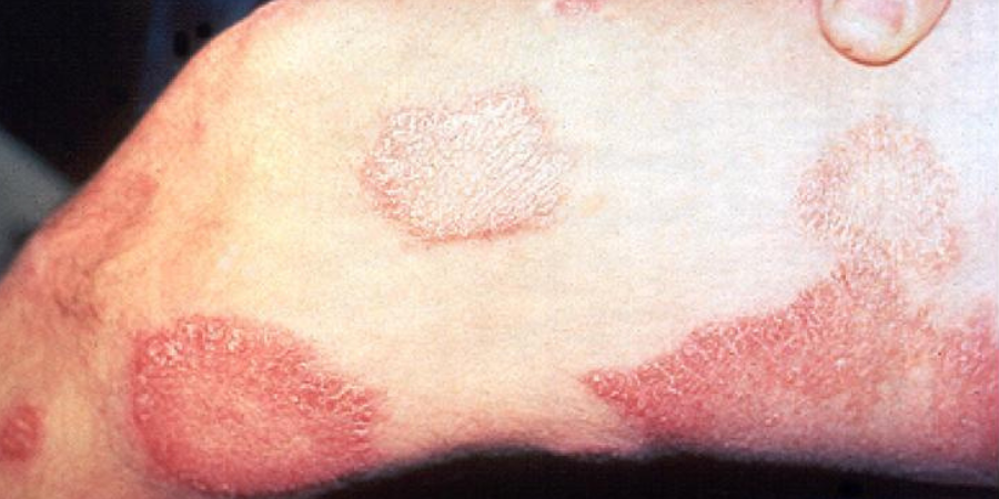 Sintomas da lepra na pele